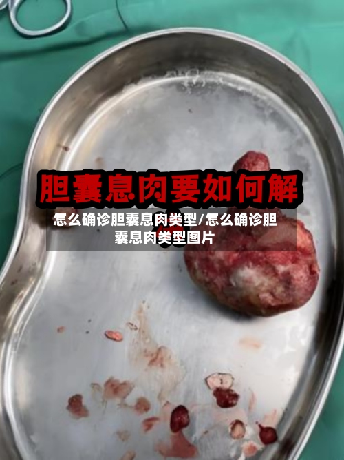 怎么确诊胆囊息肉类型/怎么确诊胆囊息肉类型图片-第2张图片