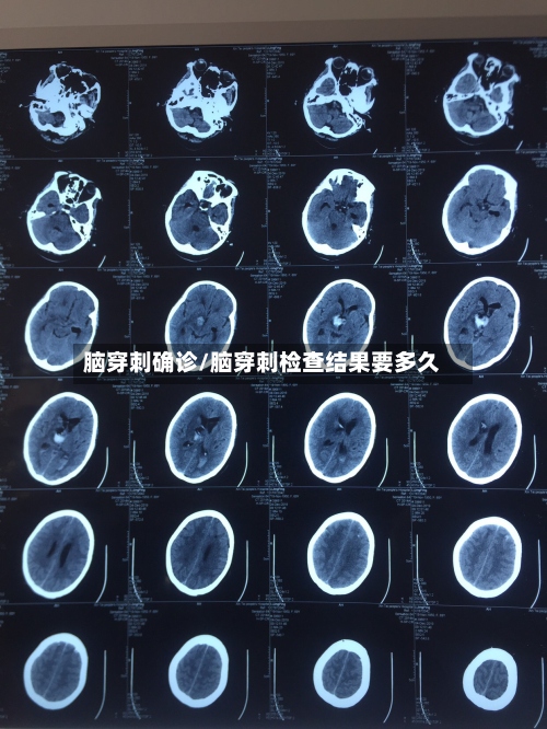 脑穿刺确诊/脑穿刺检查结果要多久
