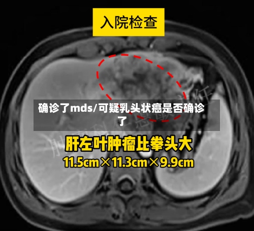 确诊了mds/可疑乳头状癌是否确诊了