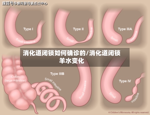 消化道闭锁如何确诊的/消化道闭锁羊水变化-第3张图片