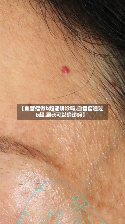 【血管瘤做b超能确诊吗,血管瘤通过b超,跟ct可以确诊吗】