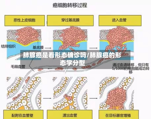 肺腺癌是看形态确诊吗/肺腺癌的形态学分型-第3张图片