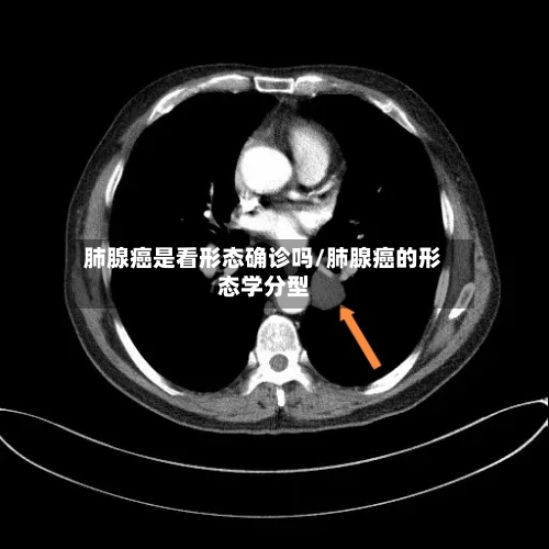 肺腺癌是看形态确诊吗/肺腺癌的形态学分型