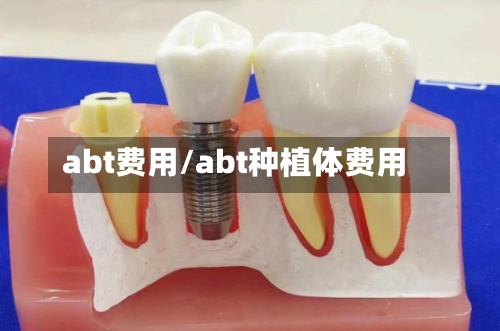 abt费用/abt种植体费用-第2张图片