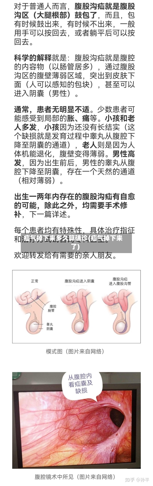 疝气掉下来多久算确诊(疝气掉下来了)
