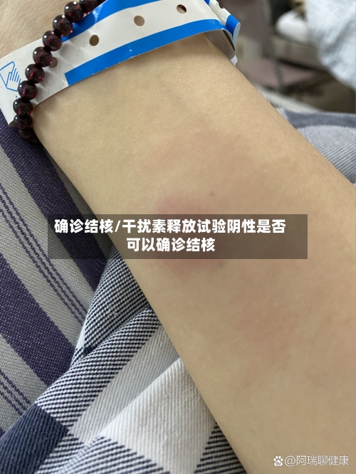 确诊结核/干扰素释放试验阴性是否可以确诊结核-第2张图片