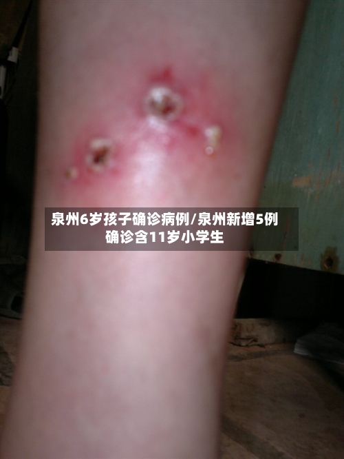 泉州6岁孩子确诊病例/泉州新增5例确诊含11岁小学生