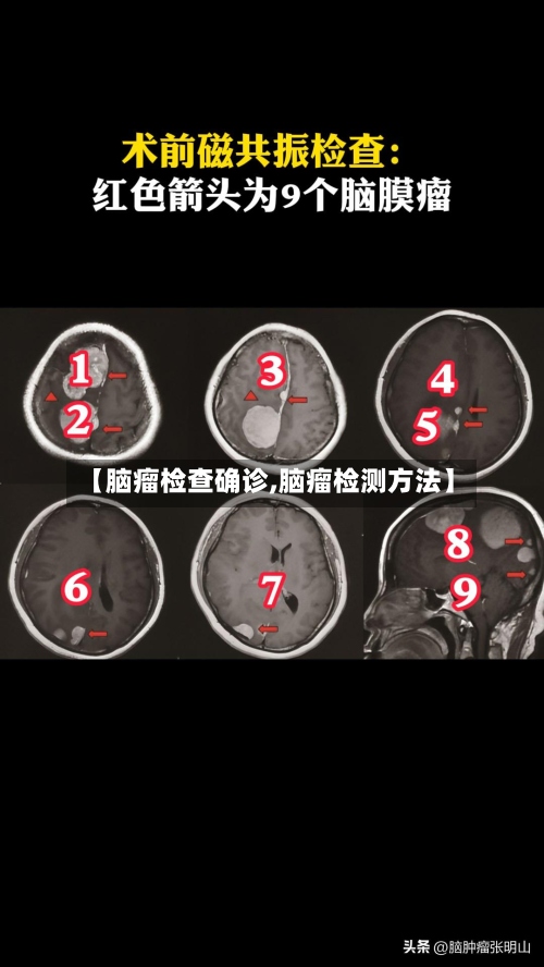 【脑瘤检查确诊,脑瘤检测方法】-第3张图片