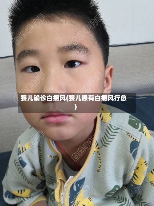 婴儿确诊白癜风(婴儿患有白癜风疗愈)-第2张图片