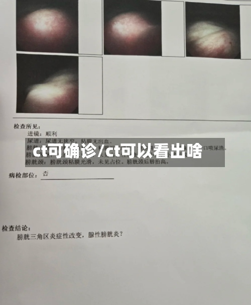 ct可确诊/ct可以看出啥-第2张图片