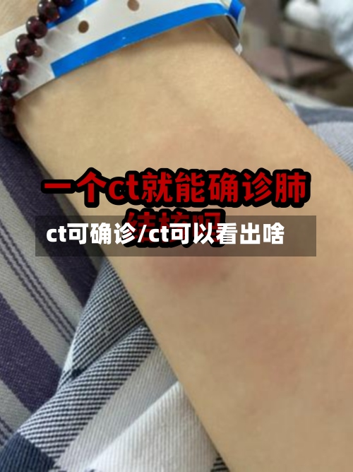 ct可确诊/ct可以看出啥-第3张图片