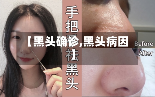 【黑头确诊,黑头病因】-第3张图片
