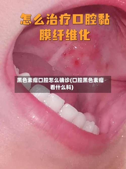 黑色素瘤口腔怎么确诊(口腔黑色素瘤看什么科)