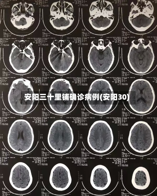 安阳三十里铺确诊病例(安阳30)