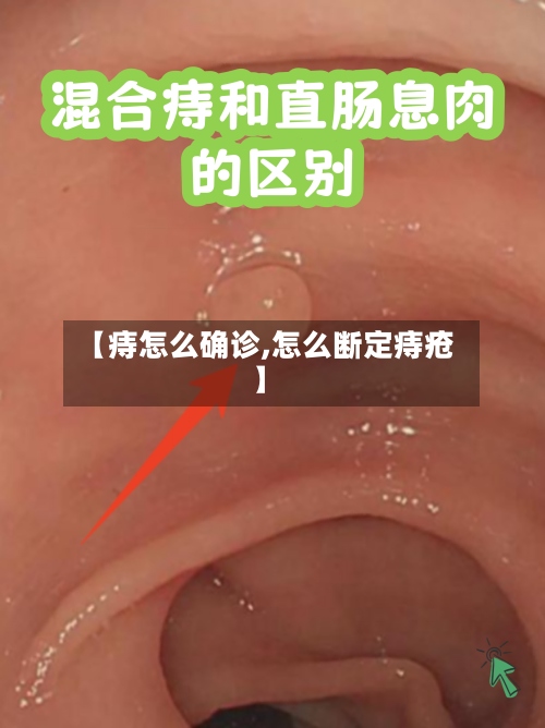 【痔怎么确诊,怎么断定痔疮】