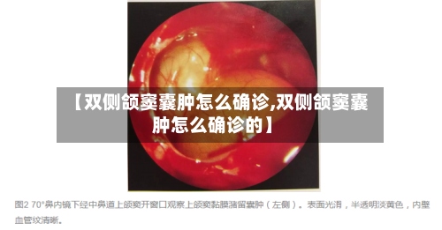 【双侧颌窦囊肿怎么确诊,双侧颌窦囊肿怎么确诊的】