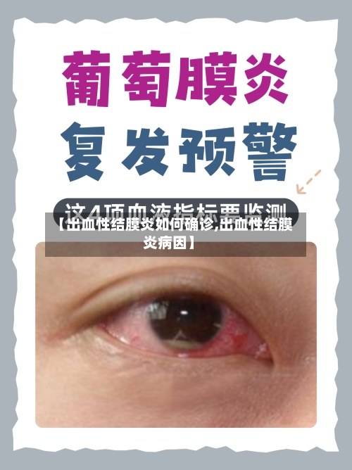 【出血性结膜炎如何确诊,出血性结膜炎病因】