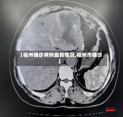 【福州确诊病例最新情况,福州市确诊】-第2张图片