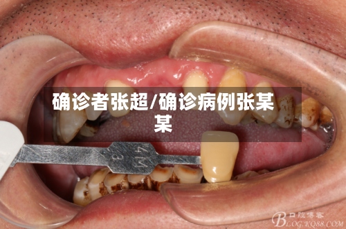 确诊者张超/确诊病例张某某-第2张图片