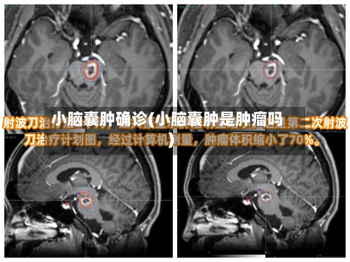 小脑囊肿确诊(小脑囊肿是肿瘤吗)-第2张图片