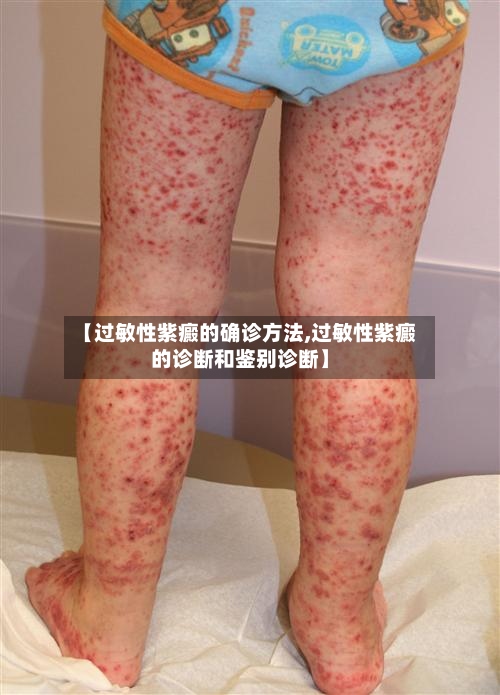 【过敏性紫癜的确诊方法,过敏性紫癜的诊断和鉴别诊断】