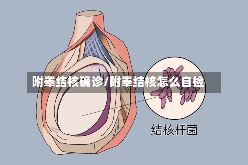 附睾结核确诊/附睾结核怎么自检