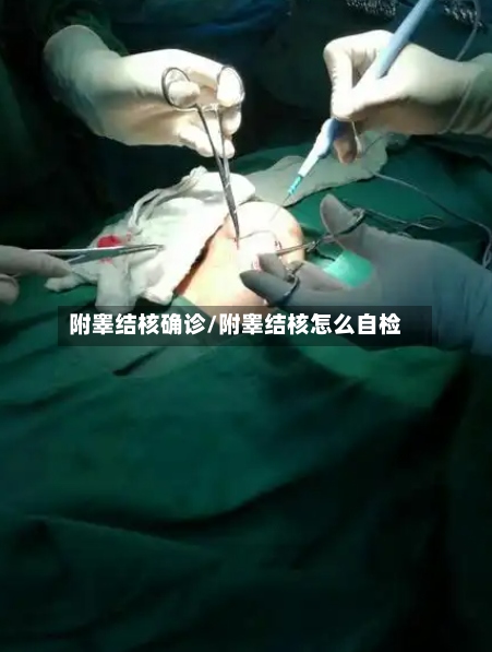 附睾结核确诊/附睾结核怎么自检-第2张图片