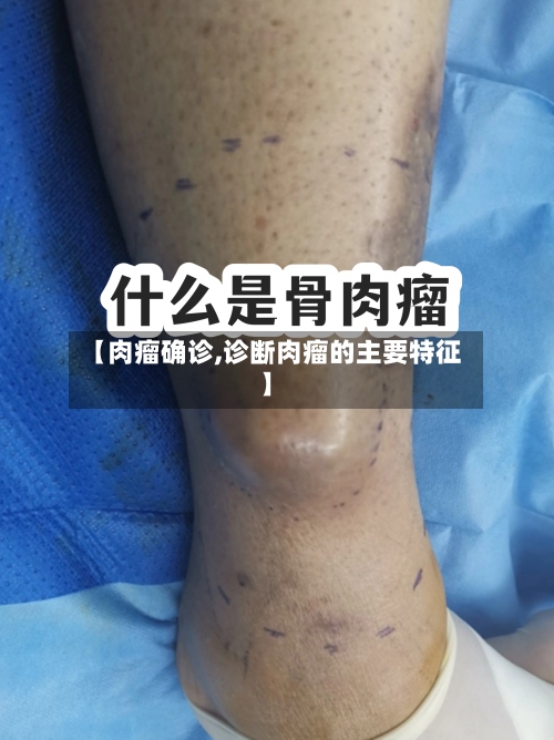 【肉瘤确诊,诊断肉瘤的主要特征】