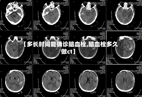 【多长时间能确诊脑血栓,脑血栓多久做ct】