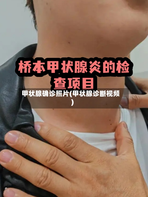 甲状腺确诊照片(甲状腺诊断视频)-第3张图片