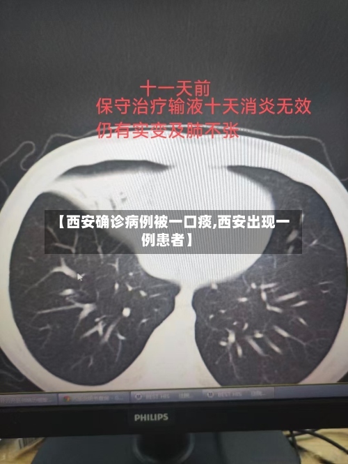 【西安确诊病例被一口痰,西安出现一例患者】-第2张图片