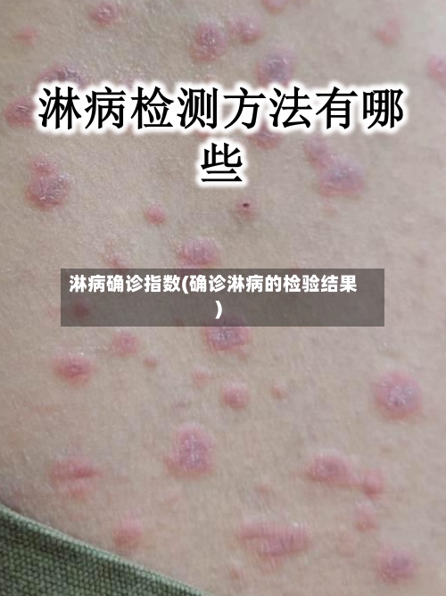 淋病确诊指数(确诊淋病的检验结果)-第2张图片