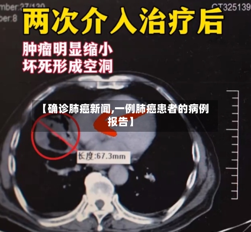 【确诊肺癌新闻,一例肺癌患者的病例报告】