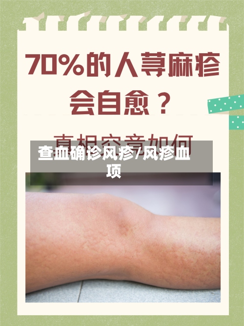 查血确诊风疹/风疹血项-第2张图片