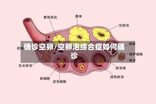确诊空卵/空卵泡综合症如何确诊