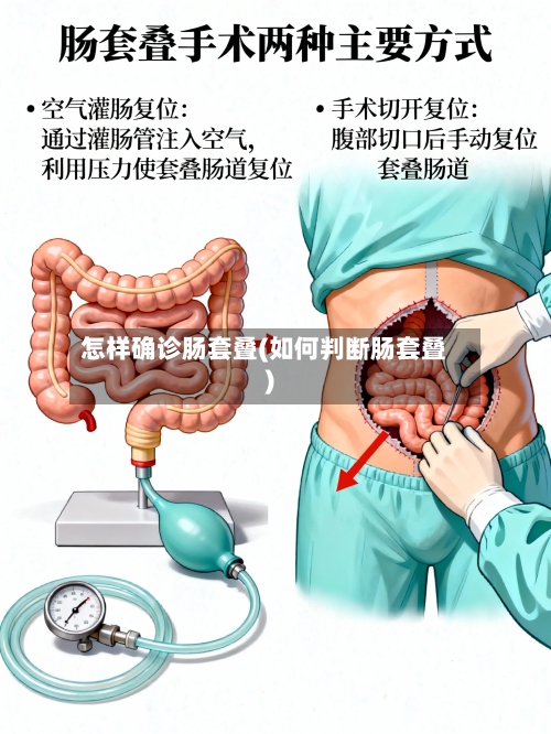 怎样确诊肠套叠(如何判断肠套叠)-第2张图片