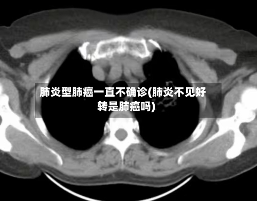 肺炎型肺癌一直不确诊(肺炎不见好转是肺癌吗)-第2张图片