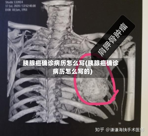 胰腺癌确诊病历怎么写(胰腺癌确诊病历怎么写的)