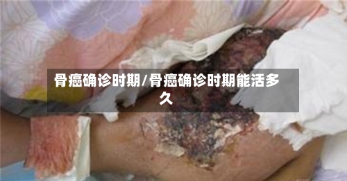 骨癌确诊时期/骨癌确诊时期能活多久