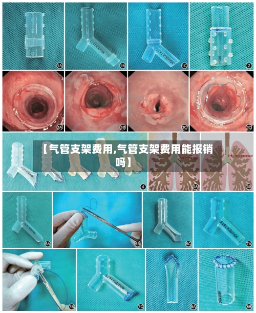 【气管支架费用,气管支架费用能报销吗】