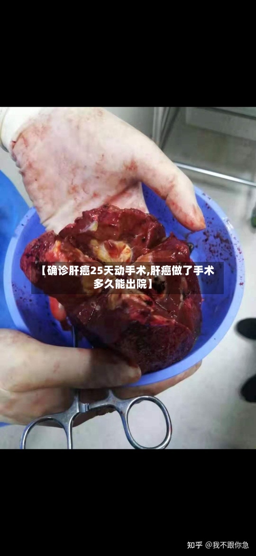 【确诊肝癌25天动手术,肝癌做了手术多久能出院】
