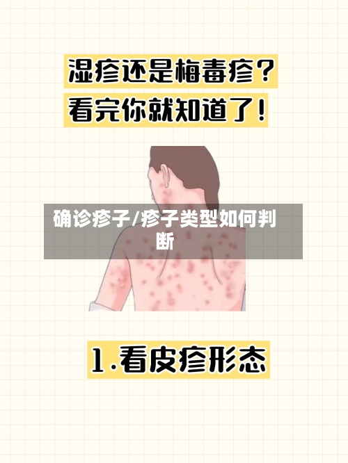 确诊疹子/疹子类型如何判断