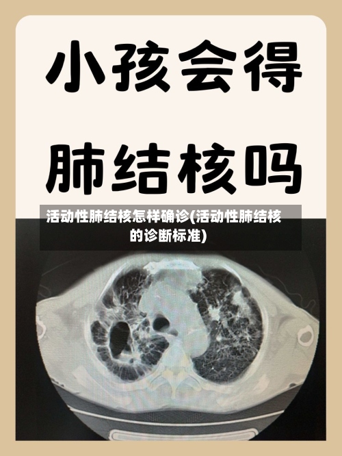 活动性肺结核怎样确诊(活动性肺结核的诊断标准)-第3张图片