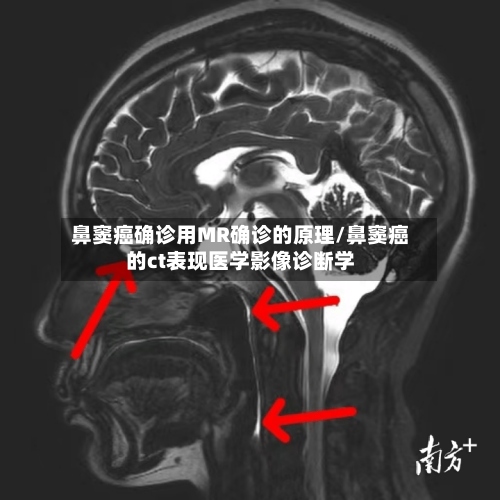 鼻窦癌确诊用MR确诊的原理/鼻窦癌的ct表现医学影像诊断学
