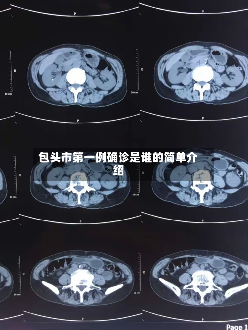 包头市第一例确诊是谁的简单介绍-第2张图片