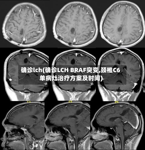 确诊lch(确诊LCH BRAF突变,颈椎C6单病灶治疗方案及时间)