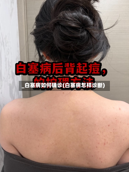 _白塞病如何确诊(白塞病怎样诊断)