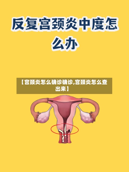 【宫颈炎怎么确诊确诊,宫颈炎怎么查出来】-第2张图片