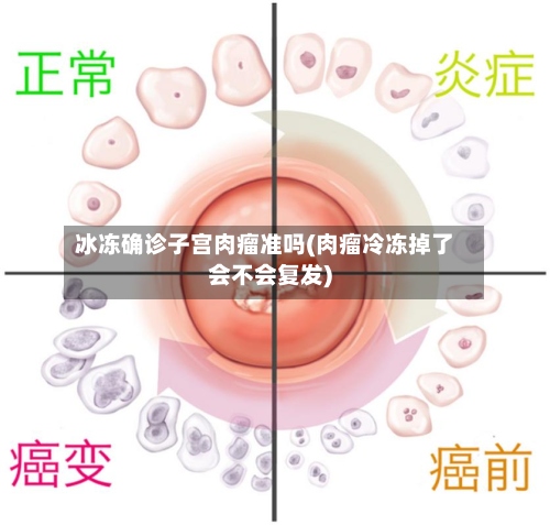 冰冻确诊子宫肉瘤准吗(肉瘤冷冻掉了会不会复发)-第2张图片