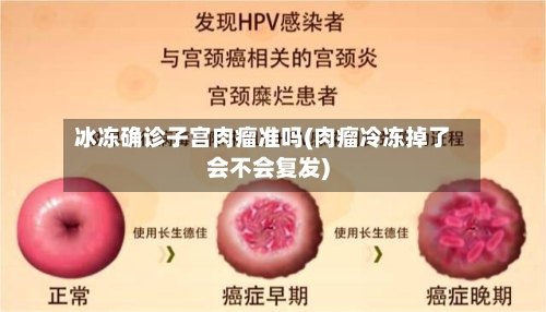 冰冻确诊子宫肉瘤准吗(肉瘤冷冻掉了会不会复发)